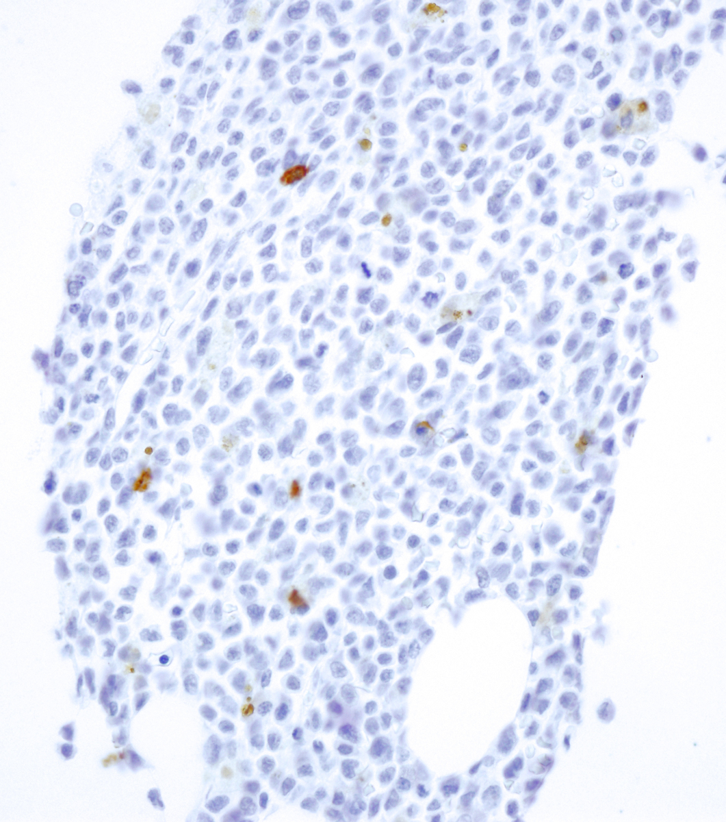 AML core biopsy CD3